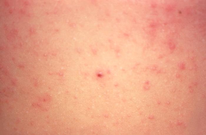 measles1